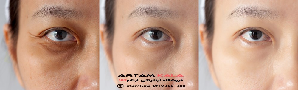 اسید ضد لک مزوپیل + آرتام کالا